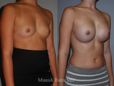 Breast Augmentation Before & After Gallery - Patient 142767 - Image 1
