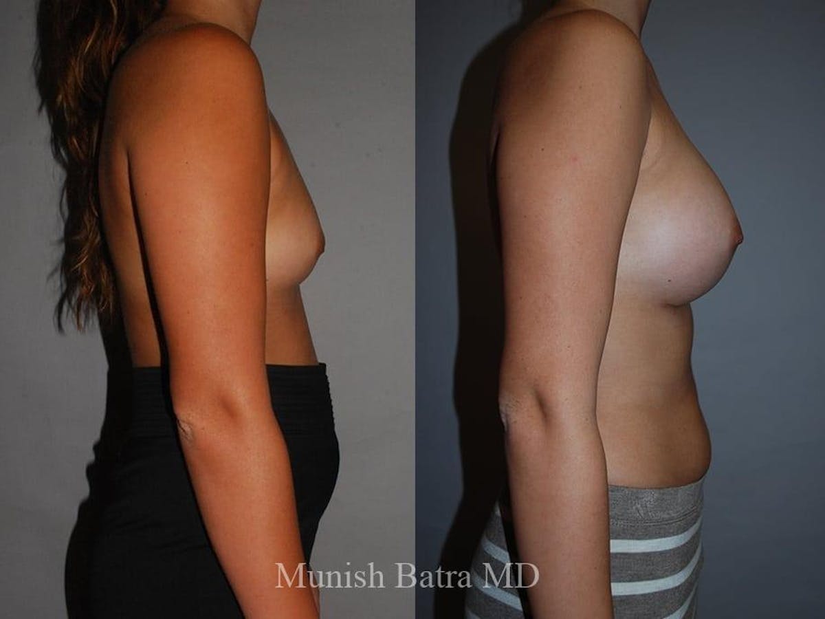 Breast Augmentation Before & After Gallery - Patient 142767 - Image 2