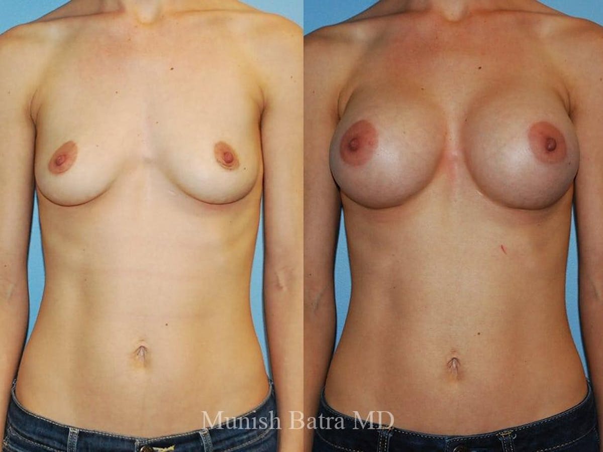 Breast Augmentation Before & After Gallery - Patient 373626 - Image 1