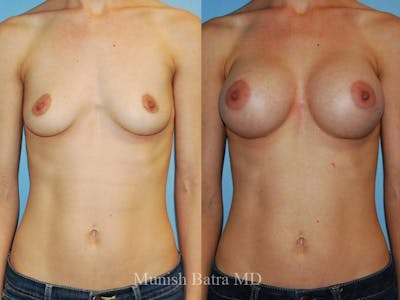 Breast Augmentation Before & After Gallery - Patient 373626 - Image 1