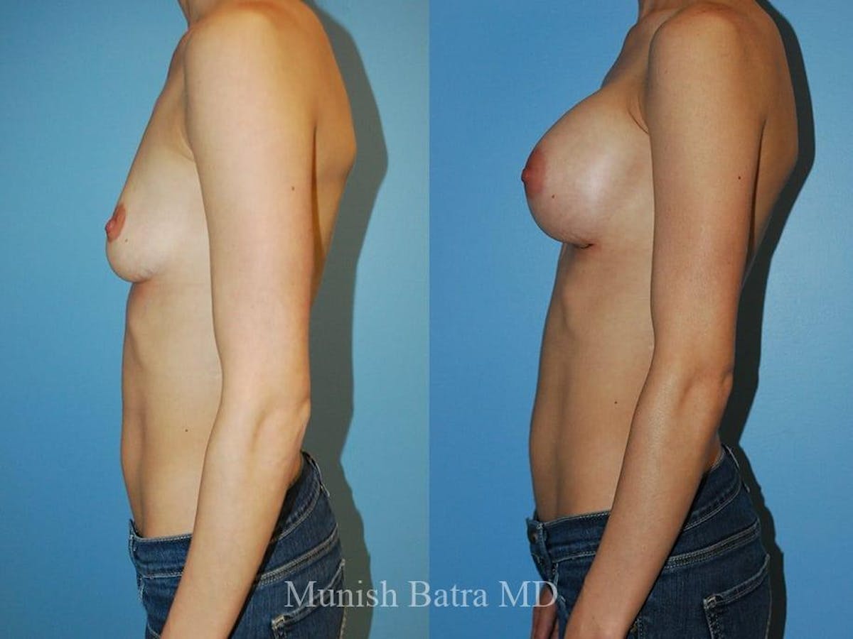 Breast Augmentation Before & After Gallery - Patient 373626 - Image 2