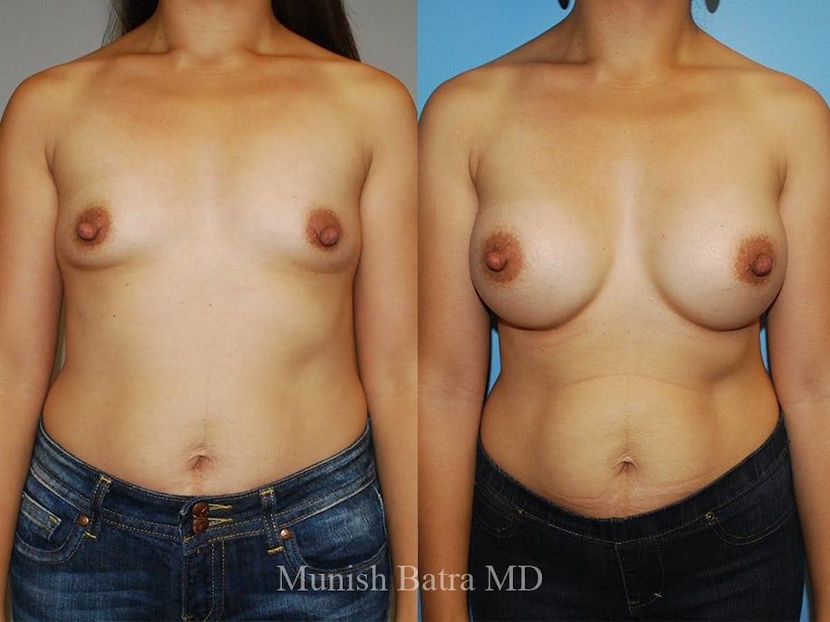 Breast Augmentation Before & After Gallery - Patient 274453 - Image 1
