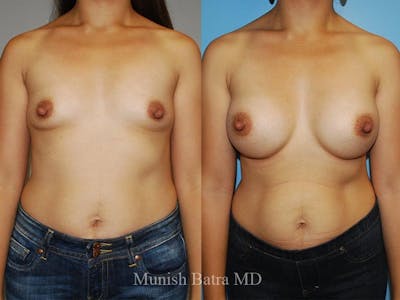 Breast Augmentation Before & After Gallery - Patient 274453 - Image 1