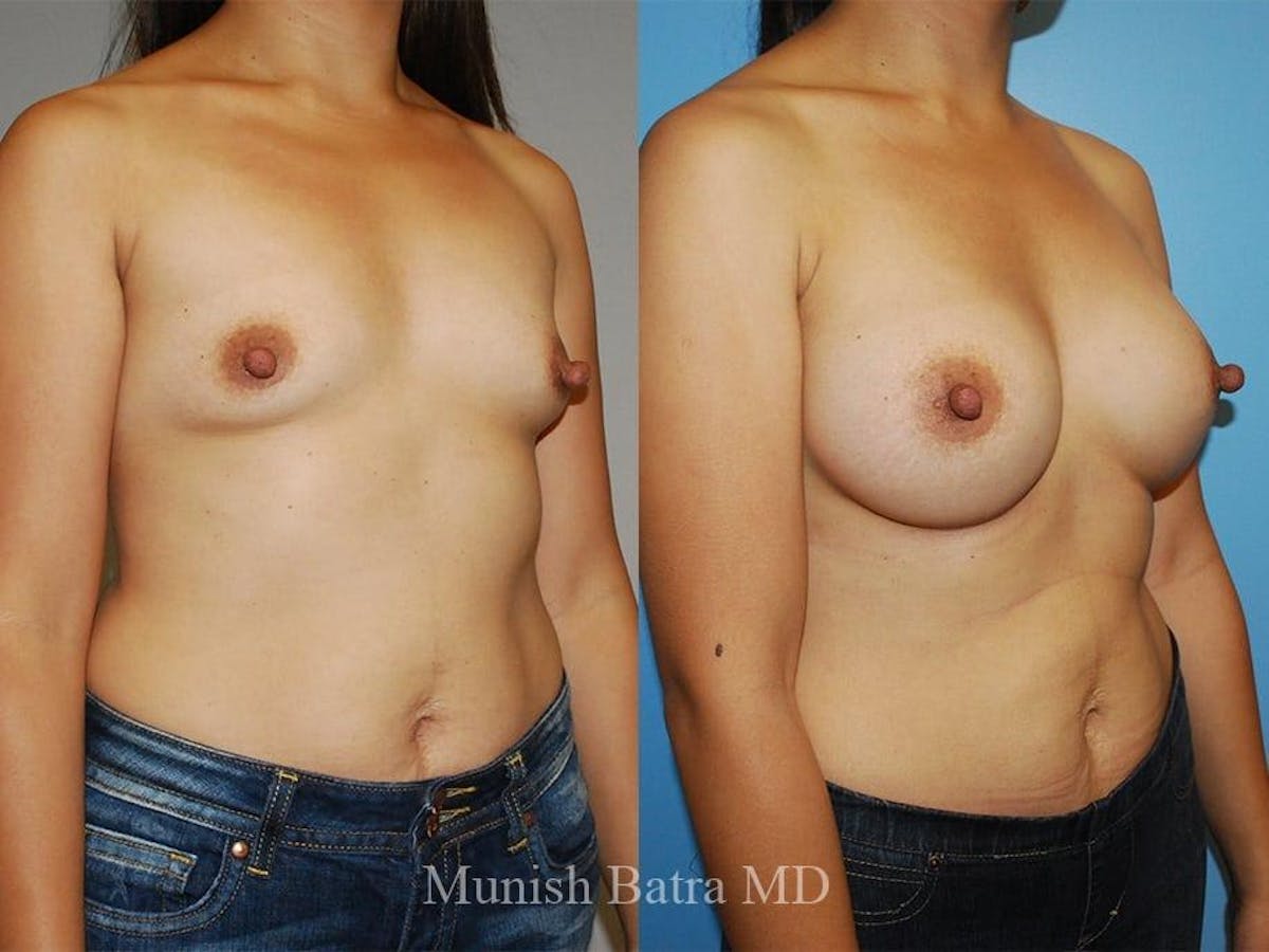Breast Augmentation Before & After Gallery - Patient 274453 - Image 2
