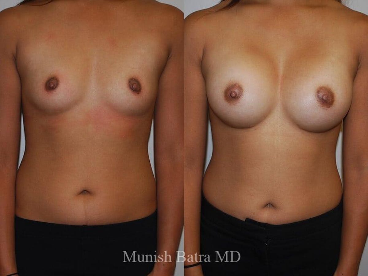 Breast Augmentation Before & After Gallery - Patient 370001 - Image 1