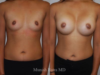 Breast Augmentation Before & After Gallery - Patient 370001 - Image 1