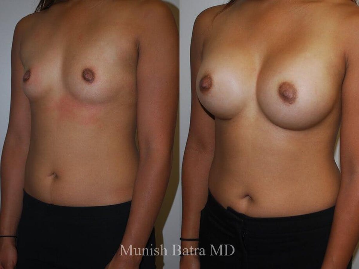 Breast Augmentation Before & After Gallery - Patient 370001 - Image 2
