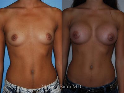 Breast Augmentation Before & After Gallery - Patient 330295 - Image 1