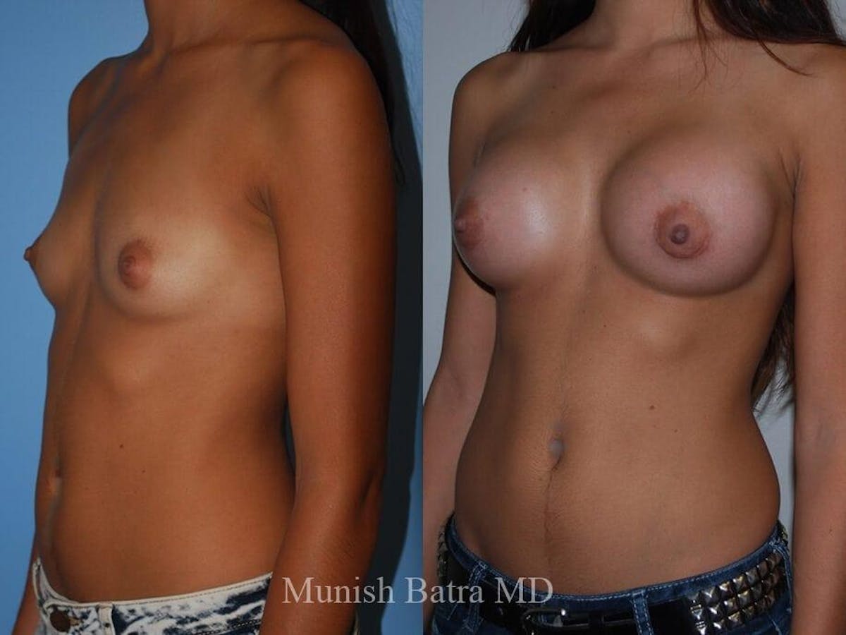 Breast Augmentation Before & After Gallery - Patient 330295 - Image 2