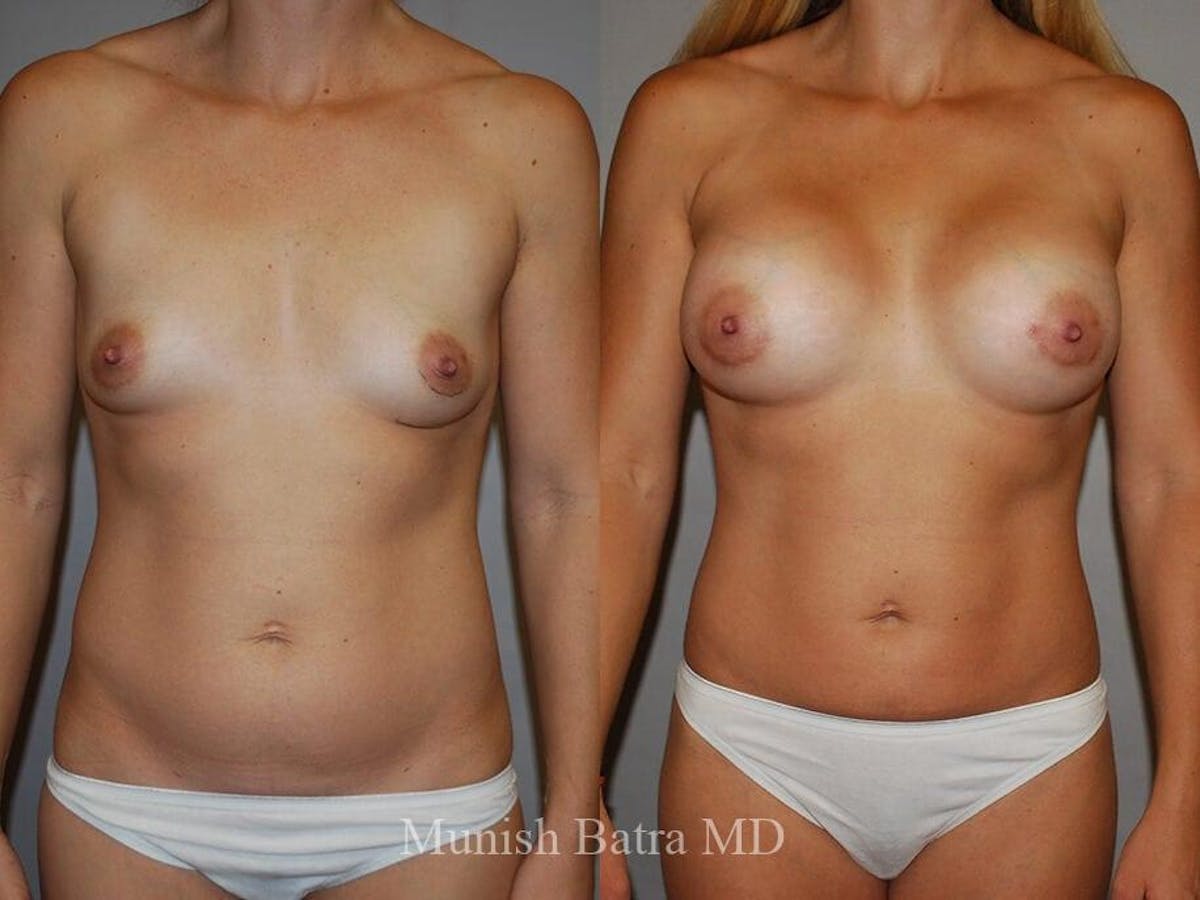 Breast Augmentation Before & After Gallery - Patient 658821 - Image 1