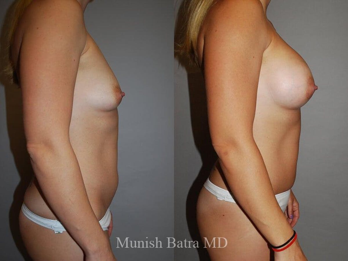 Breast Augmentation Before & After Gallery - Patient 658821 - Image 2