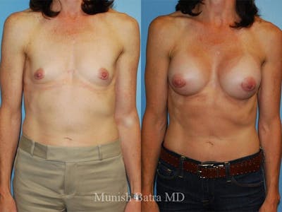 Breast Augmentation Before & After Gallery - Patient 140900 - Image 1