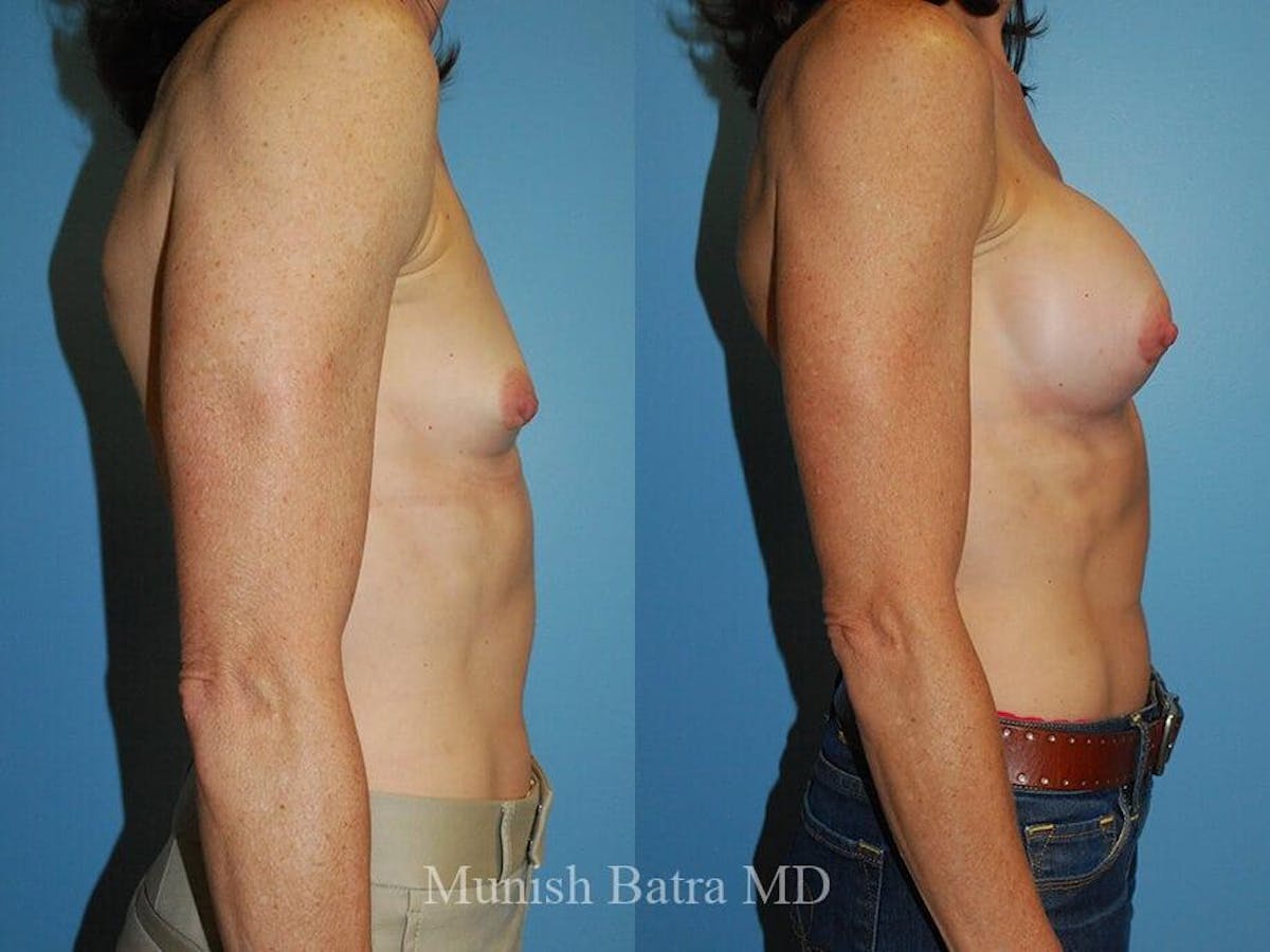 Breast Augmentation Before & After Gallery - Patient 140900 - Image 2
