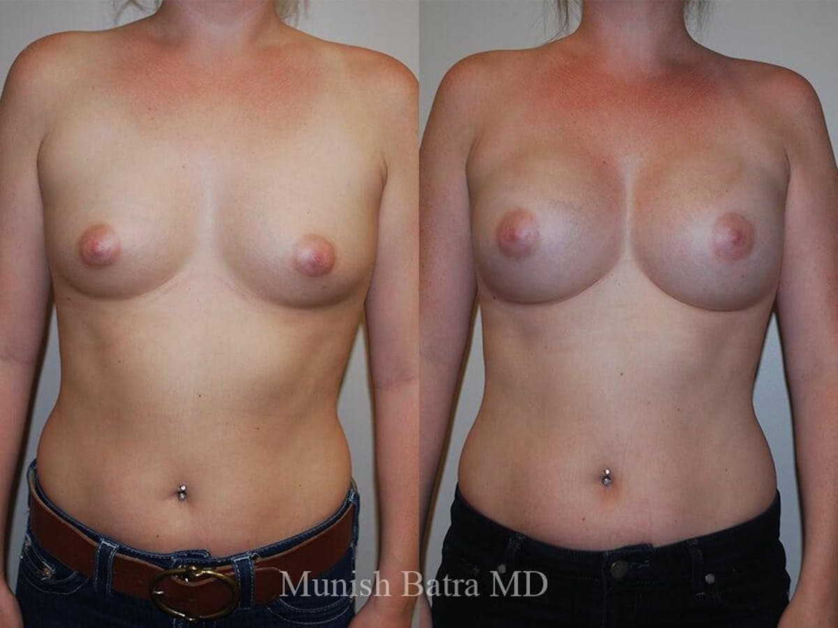 Breast Augmentation Before & After Gallery - Patient 122520 - Image 1