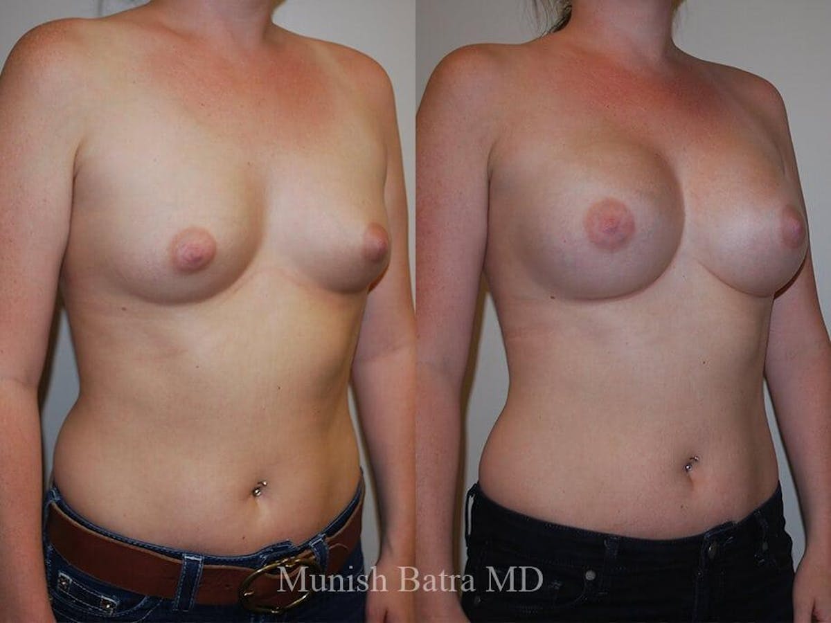 Breast Augmentation Before & After Gallery - Patient 122520 - Image 2