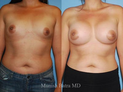 Breast Augmentation Before & After Gallery - Patient 251894 - Image 1