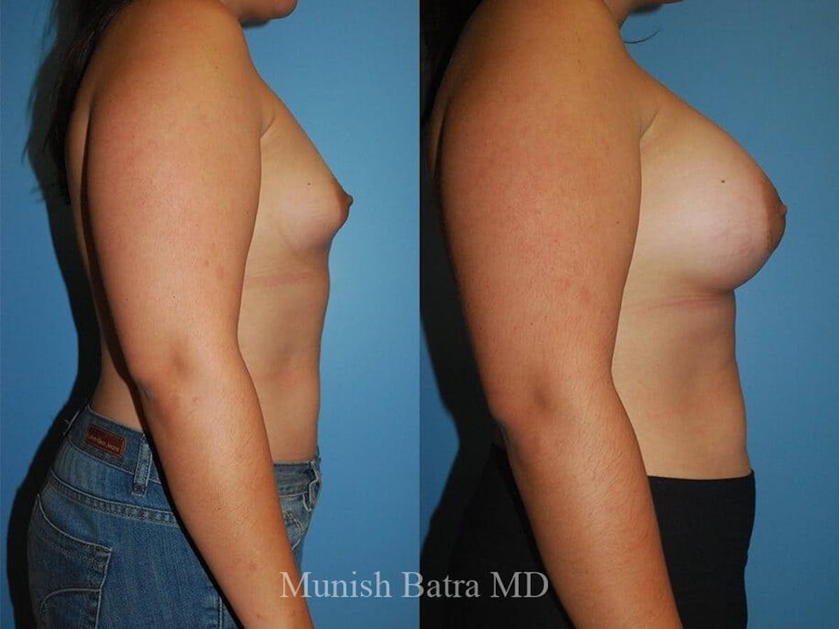 Breast Augmentation Before & After Gallery - Patient 251894 - Image 2