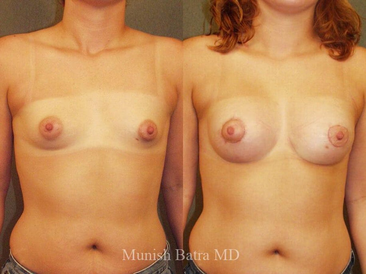 Breast Augmentation Before & After Gallery - Patient 353357 - Image 1