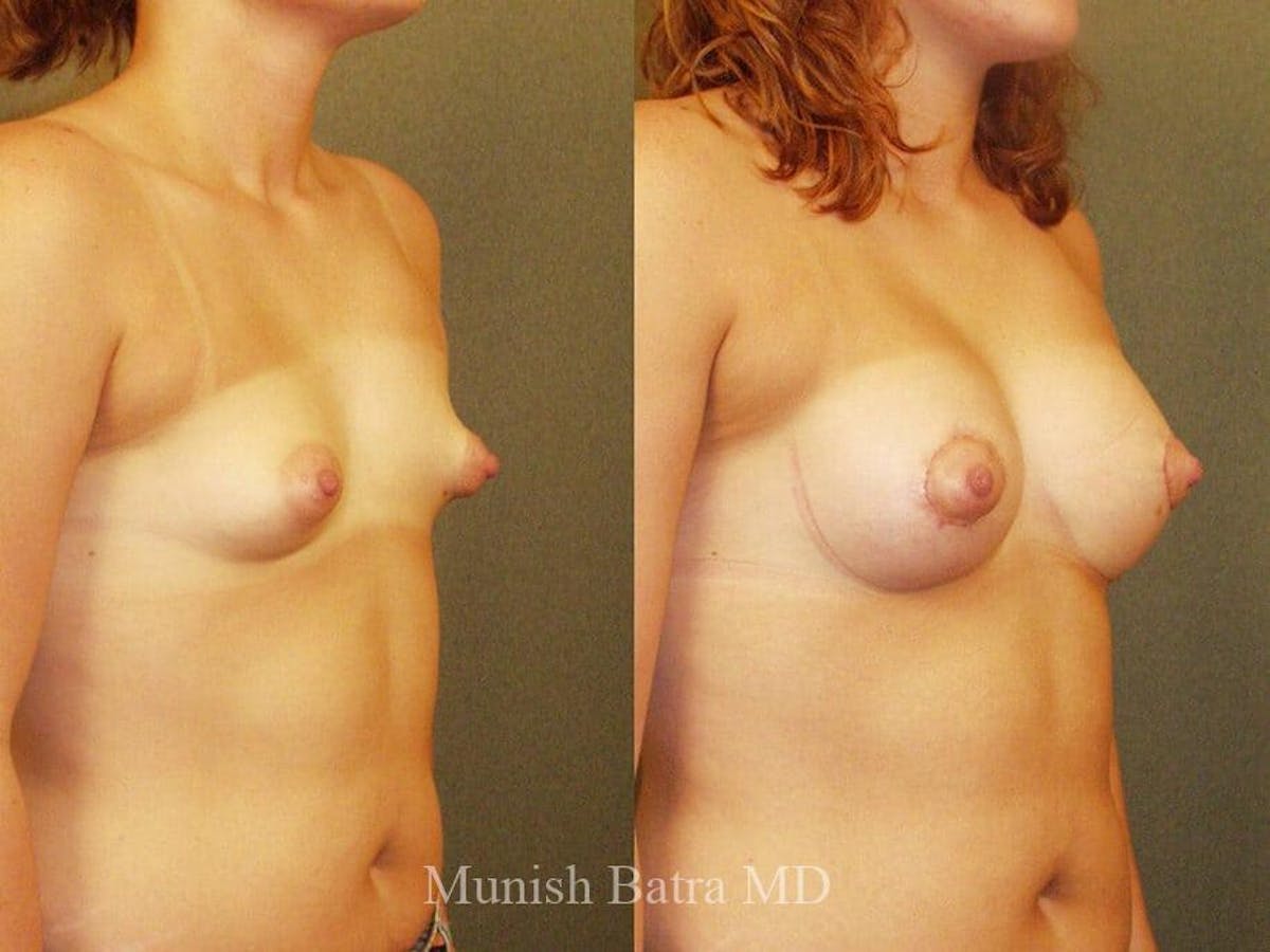 Breast Augmentation Before & After Gallery - Patient 353357 - Image 2