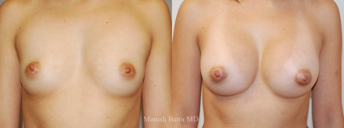 Breast Augmentation Before & After Gallery - Patient 376720 - Image 1