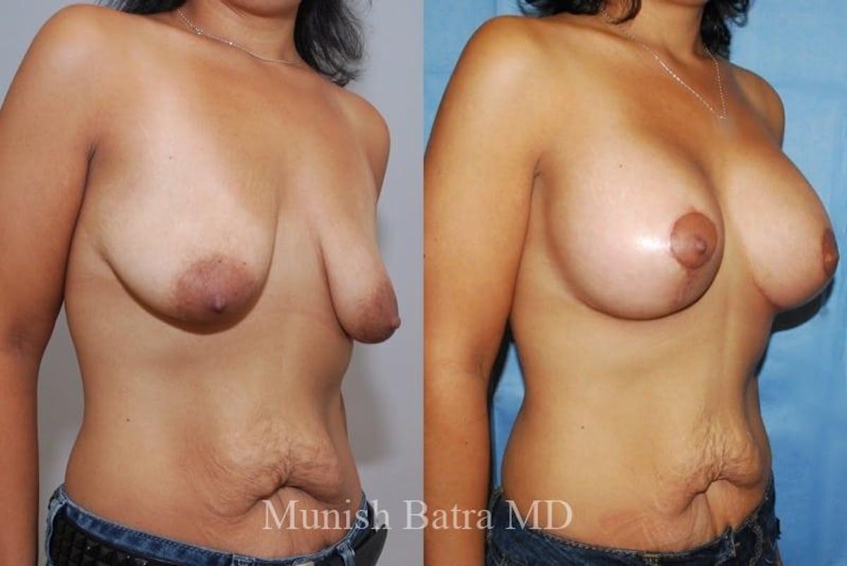 Breast Augmentation with Lift Mastopexy Before & After Gallery - Patient 254211 - Image 1