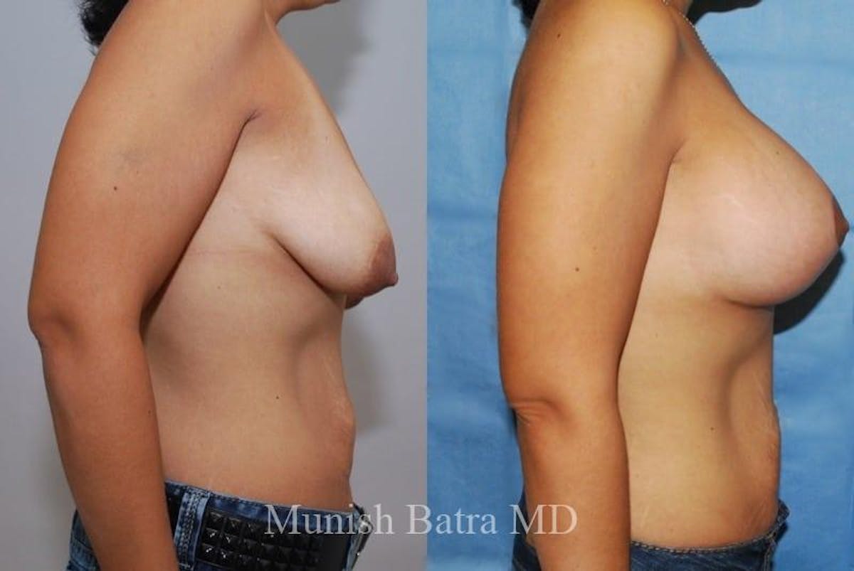 Breast Augmentation with Lift Mastopexy Before & After Gallery - Patient 254211 - Image 2