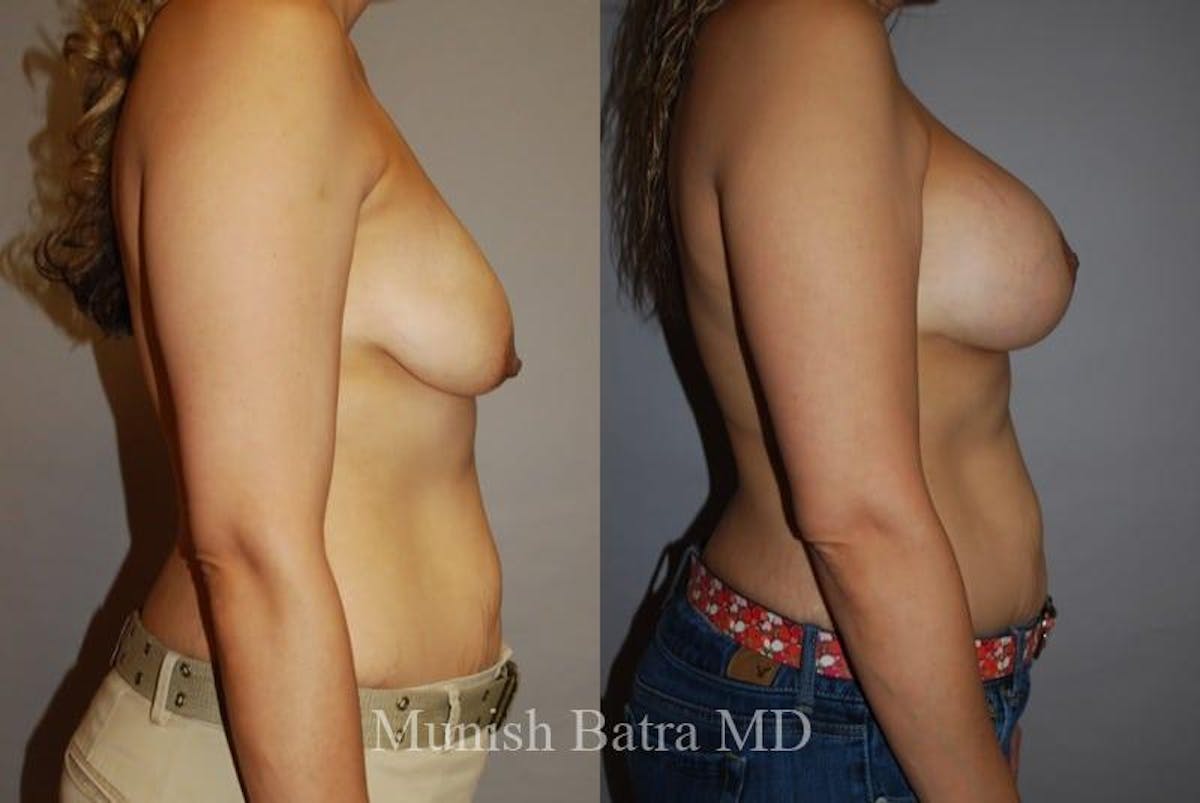 Breast Augmentation with Lift Mastopexy Before & After Gallery - Patient 850516 - Image 2