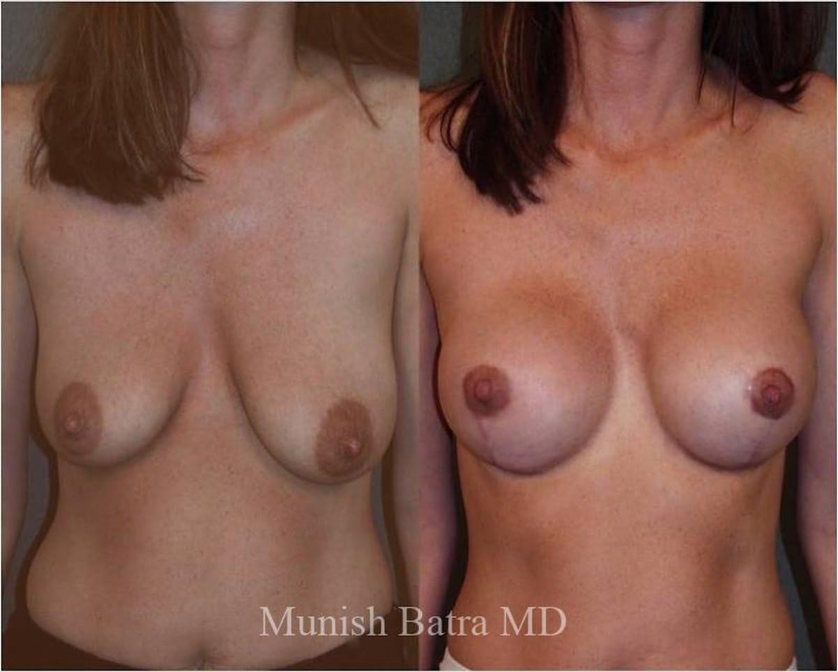 Breast Augmentation with Lift Mastopexy Before & After Gallery - Patient 616739 - Image 1