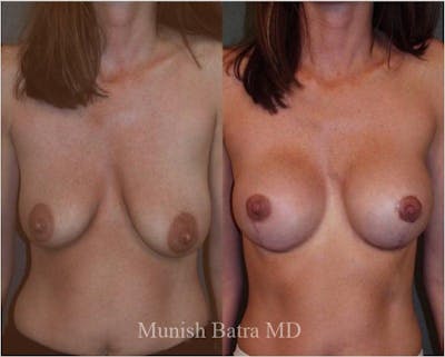 Breast Augmentation with Lift Mastopexy Before & After Gallery - Patient 616739 - Image 1