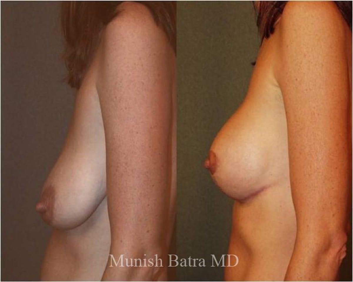 Breast Augmentation with Lift Mastopexy Before & After Gallery - Patient 616739 - Image 2