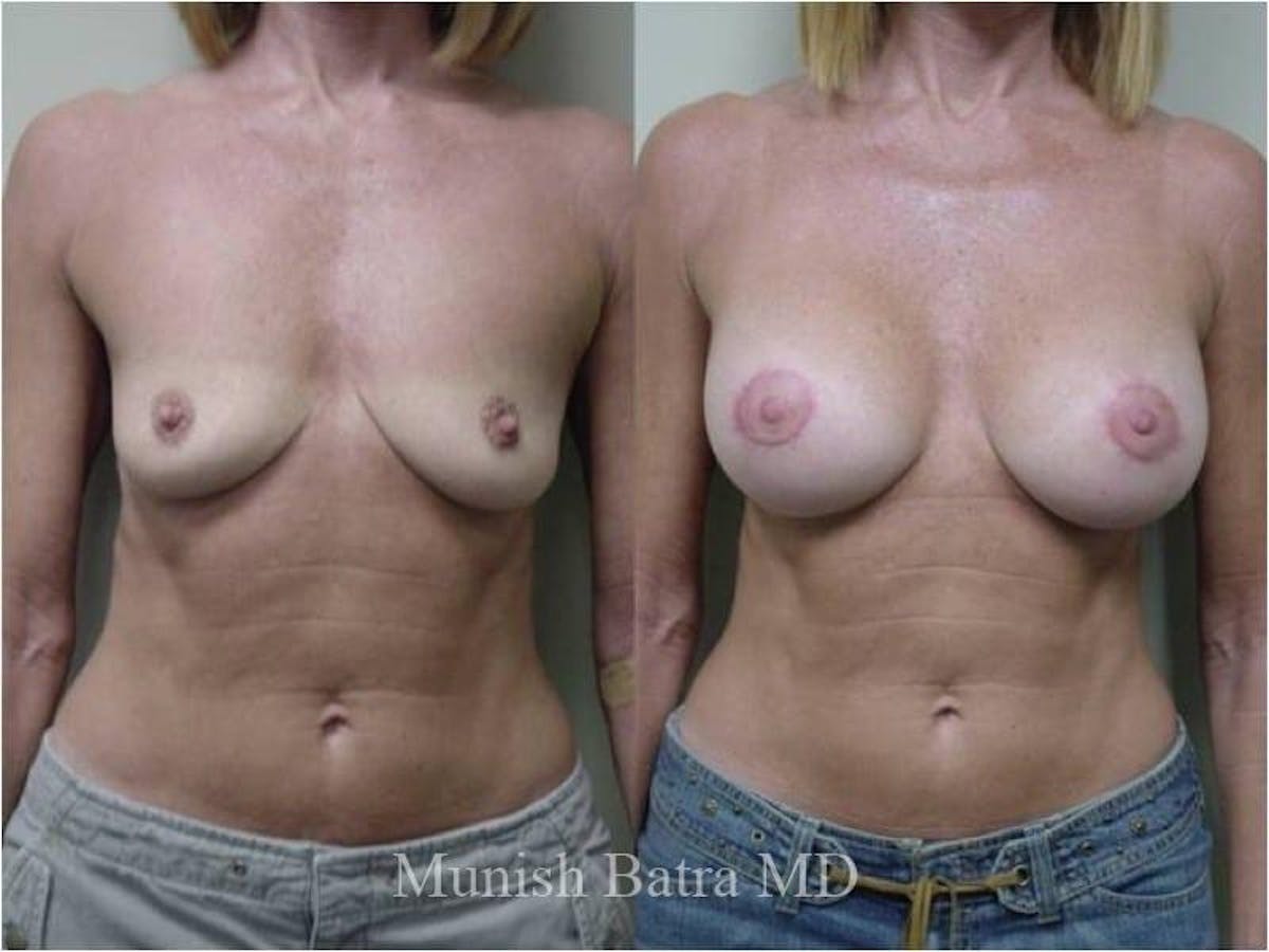 Breast Augmentation with Lift Mastopexy Before & After Gallery - Patient 132654 - Image 1