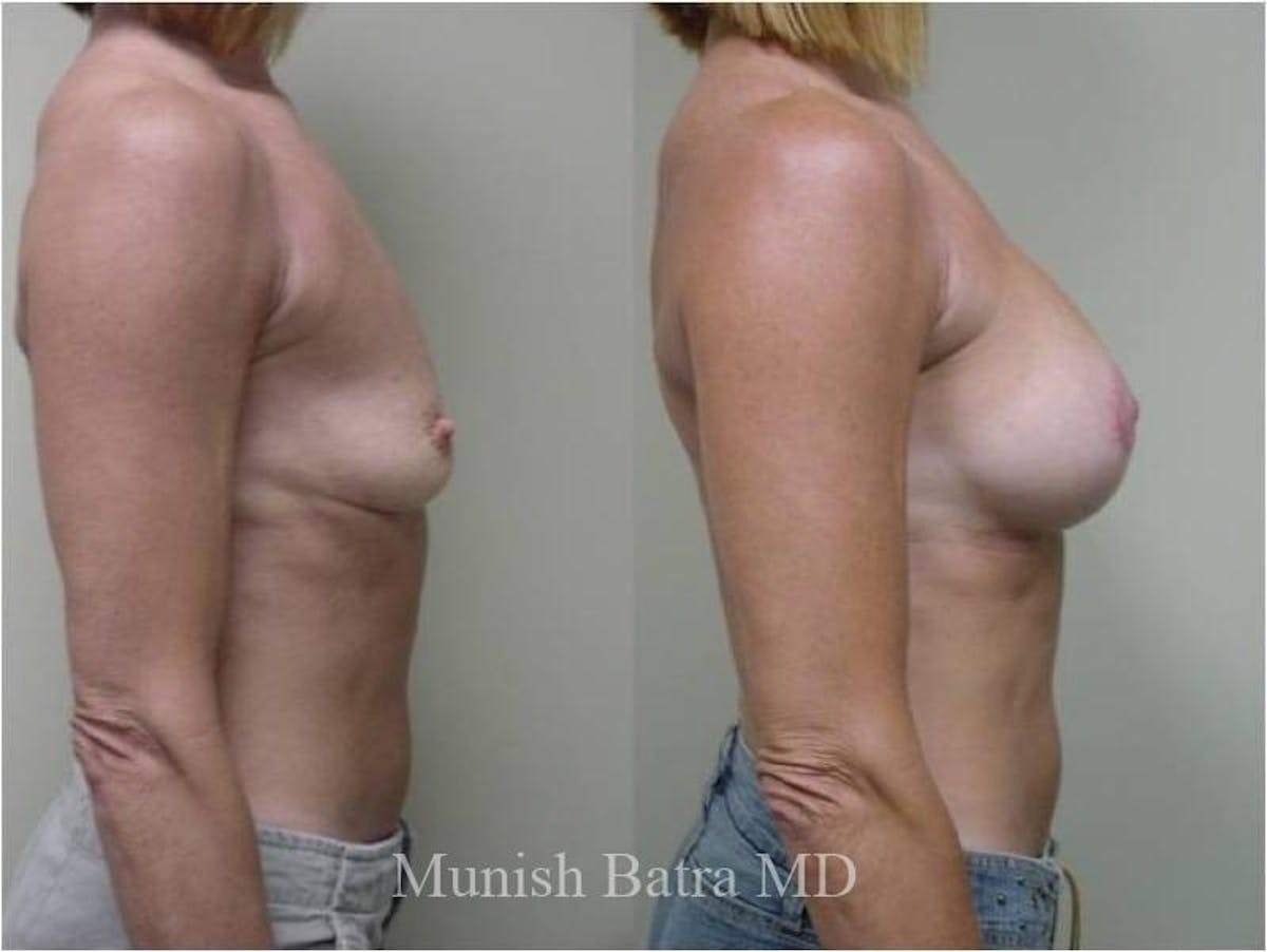Breast Augmentation with Lift Mastopexy Before & After Gallery - Patient 132654 - Image 2