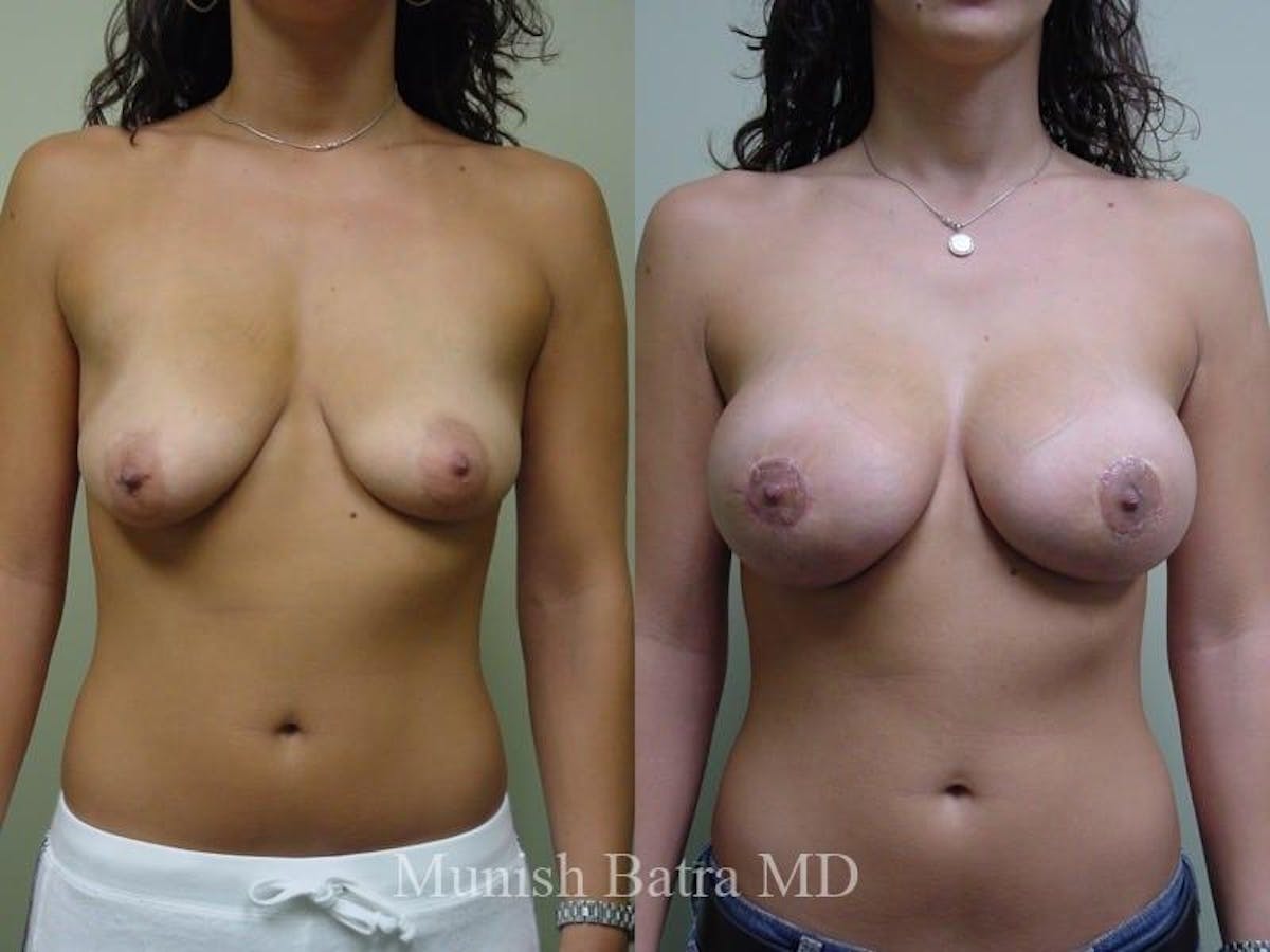 Breast Augmentation with Lift Mastopexy Before & After Gallery - Patient 140625 - Image 1