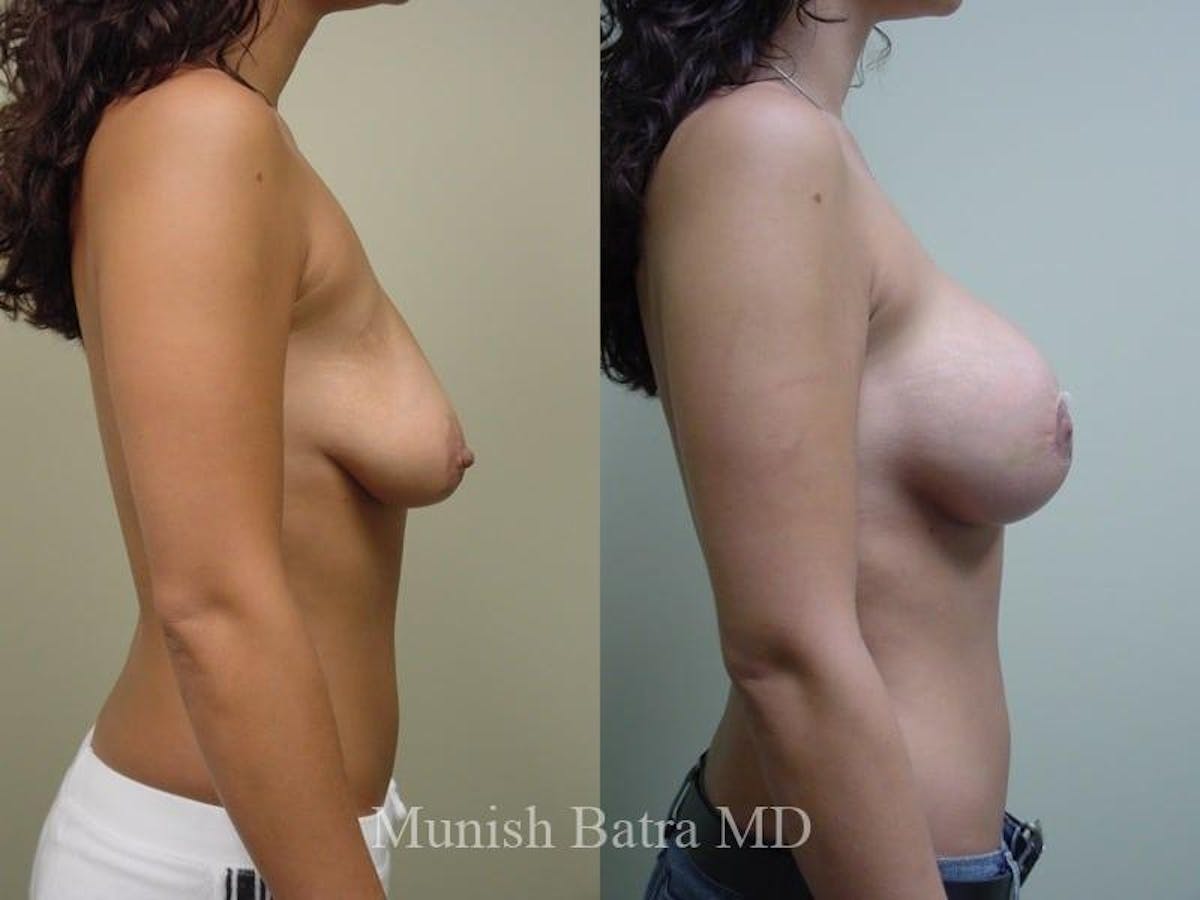 Breast Augmentation with Lift Mastopexy Before & After Gallery - Patient 140625 - Image 2