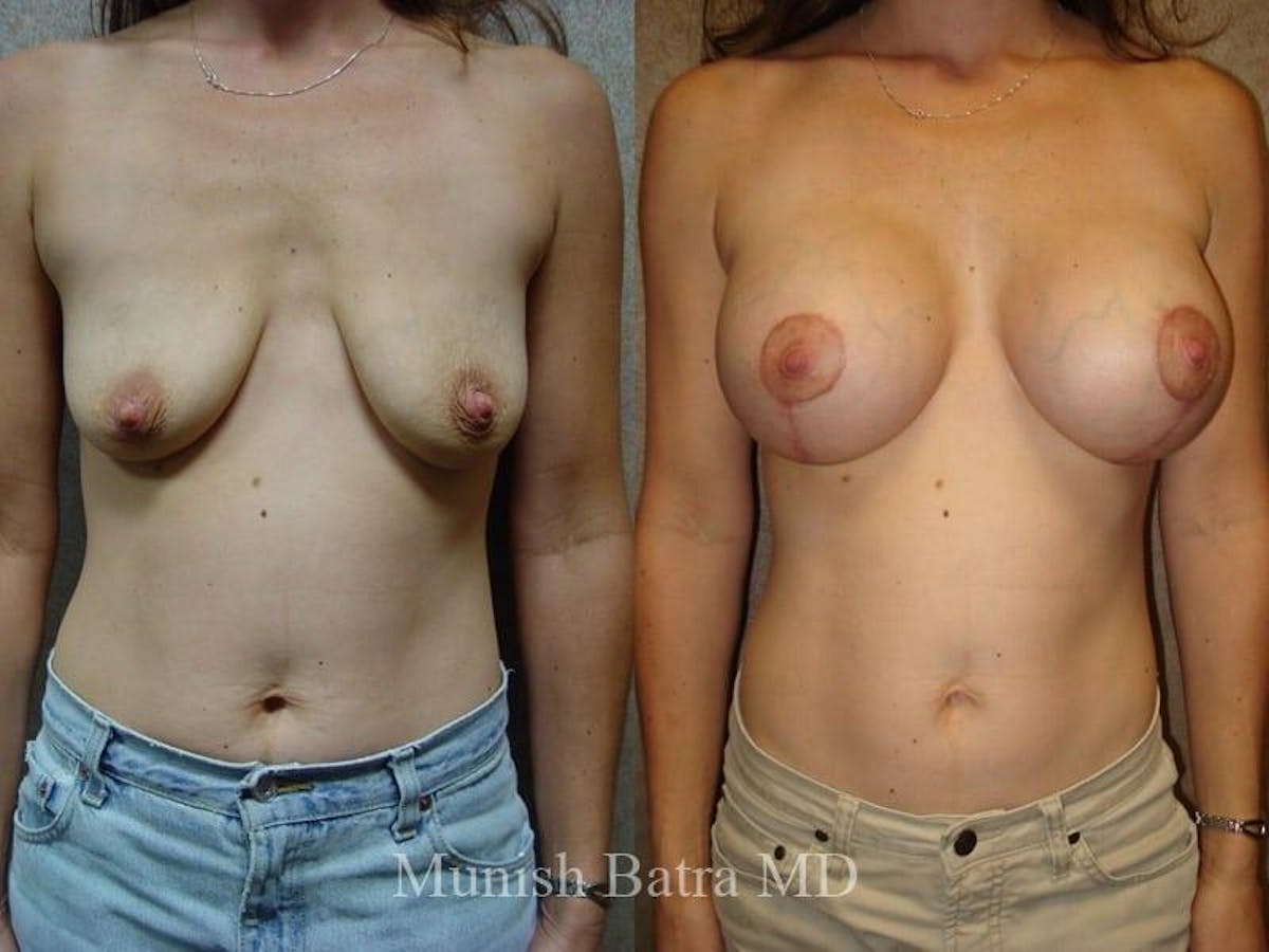 Breast Augmentation with Lift Mastopexy Before & After Gallery - Patient 224997 - Image 1