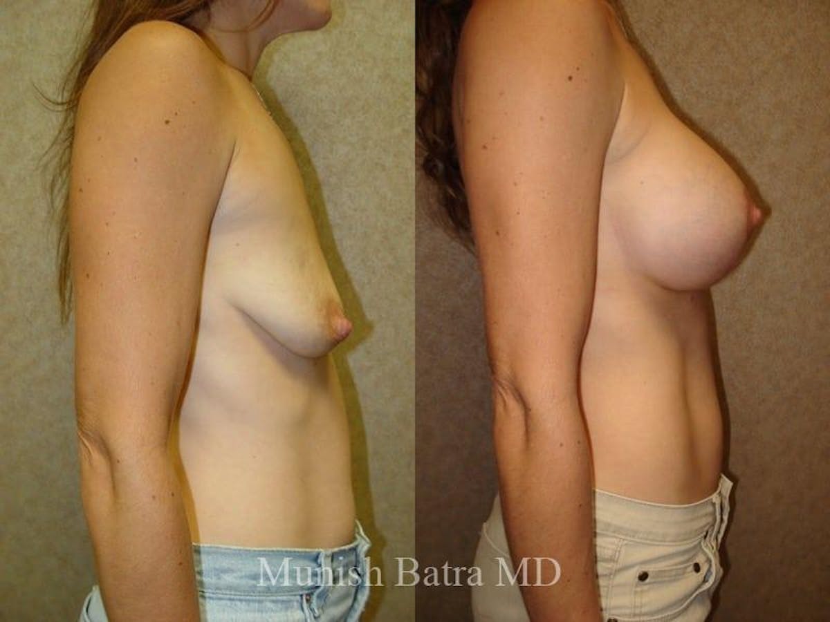 Breast Augmentation with Lift Mastopexy Before & After Gallery - Patient 224997 - Image 2