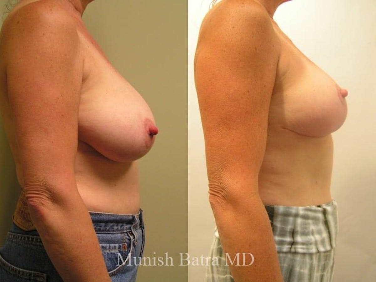 Breast Lift – Reduction Before & After Gallery - Patient 170201 - Image 2