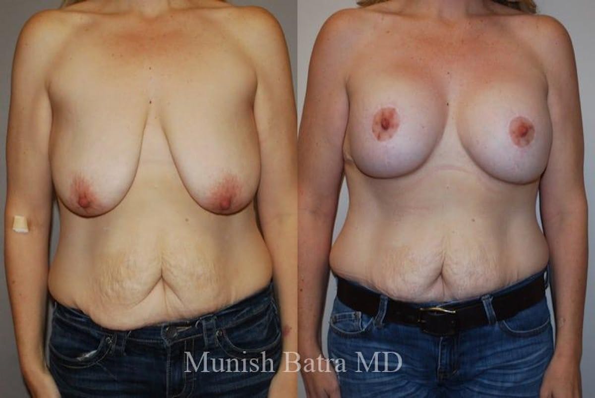 Breast Augmentation with Lift Mastopexy Before & After Gallery - Patient 121280 - Image 1
