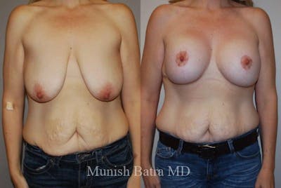 Breast Augmentation with Lift Mastopexy Before & After Gallery - Patient 121280 - Image 1