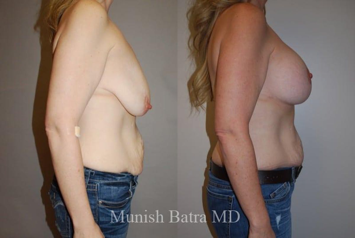 Breast Augmentation with Lift Mastopexy Before & After Gallery - Patient 121280 - Image 2