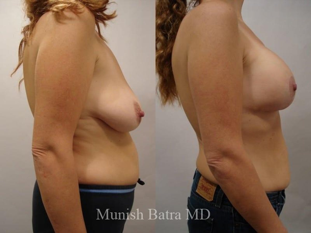 Breast Augmentation with Lift Mastopexy Before & After Gallery - Patient 117803 - Image 2