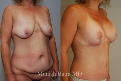 Breast Augmentation with Lift Mastopexy Before & After Gallery - Patient 328089 - Image 1