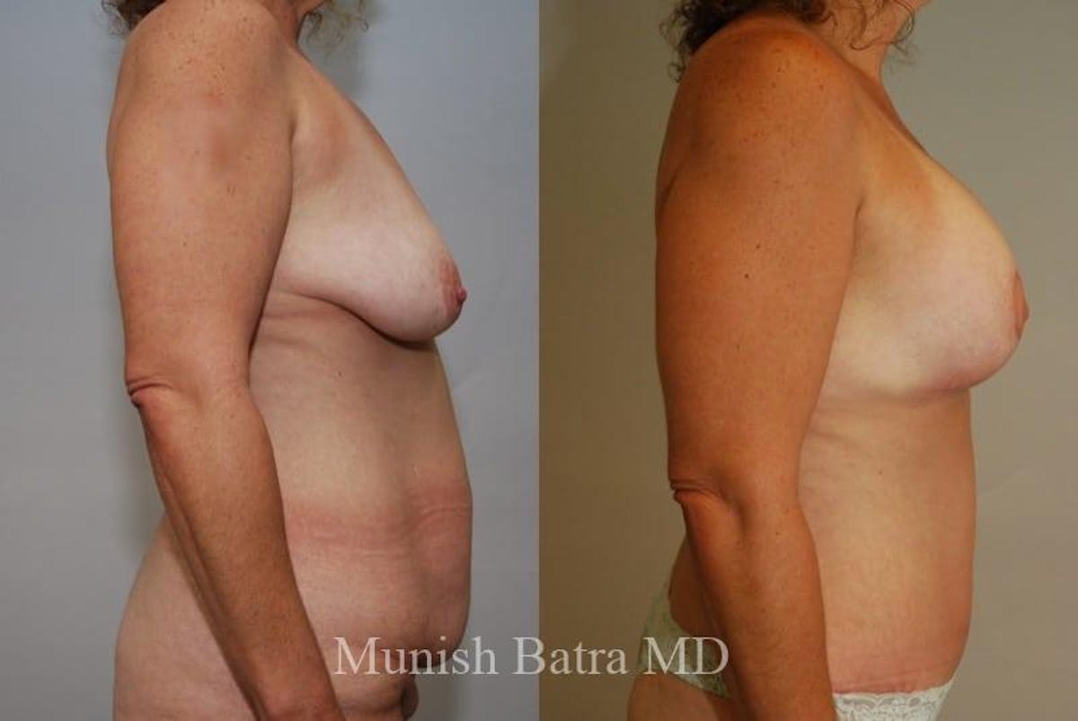 Breast Augmentation with Lift Mastopexy Before & After Gallery - Patient 328089 - Image 2