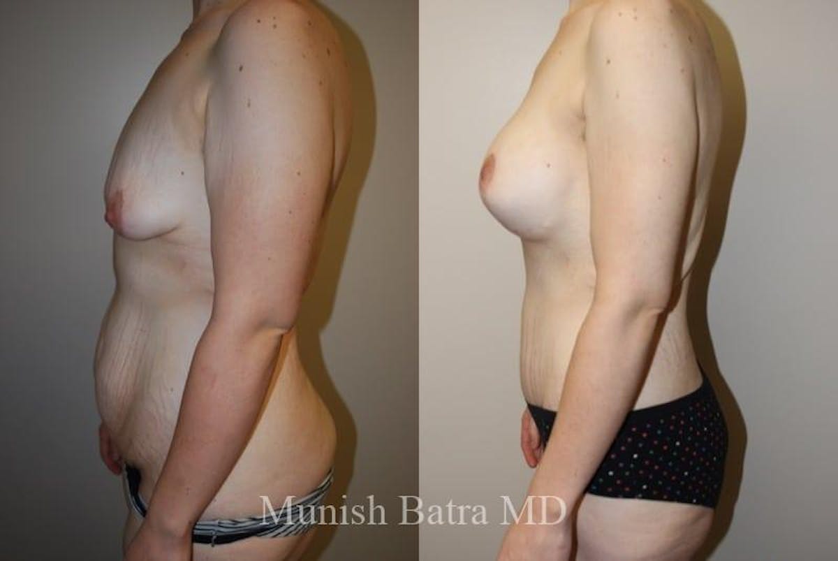 Breast Augmentation with Lift Mastopexy Before & After Gallery - Patient 356670 - Image 3
