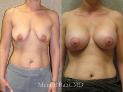 Breast Augmentation with Lift Mastopexy Before & After Gallery - Patient 686355 - Image 1