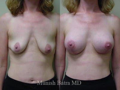 Breast Augmentation with Lift Mastopexy Before & After Gallery - Patient 133159 - Image 1