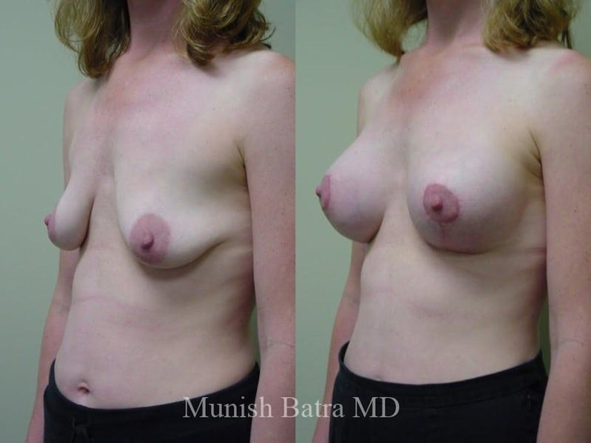 Breast Augmentation with Lift Mastopexy Before & After Gallery - Patient 133159 - Image 2