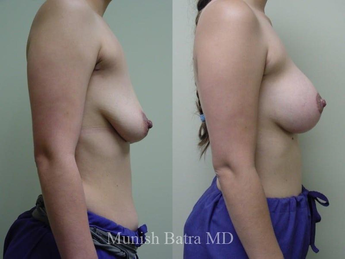 Breast Augmentation with Lift Mastopexy Before & After Gallery - Patient 363465 - Image 3