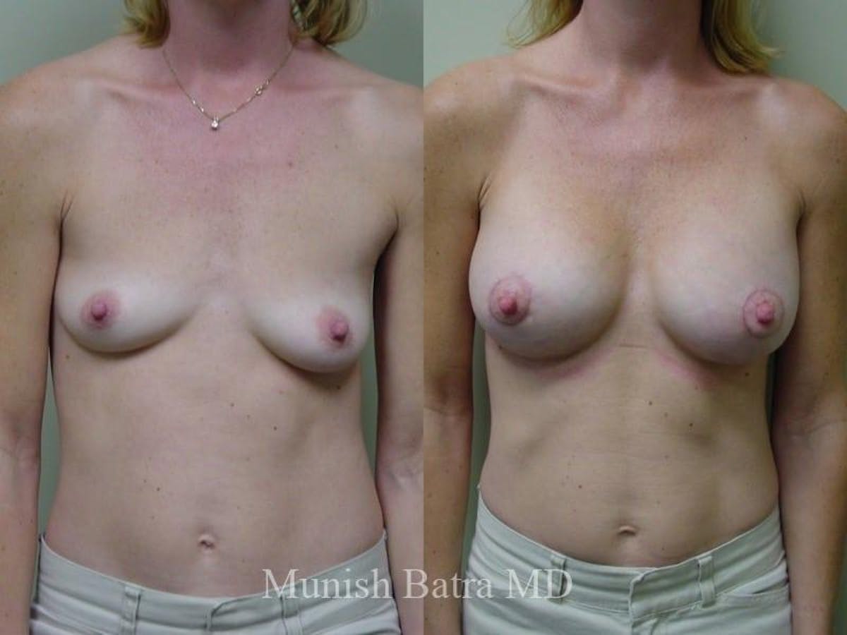 Breast Augmentation with Lift Mastopexy Before & After Gallery - Patient 172042 - Image 1