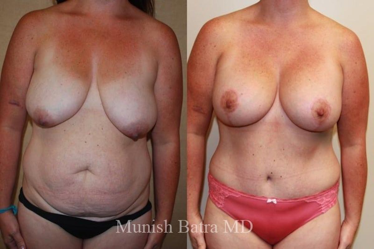 Breast Augmentation with Lift Mastopexy Before & After Gallery - Patient 193315 - Image 1
